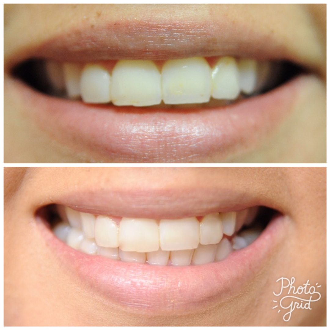 Easy and Cheap at home Teeth Whitening... Belu Barriga
